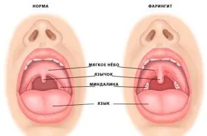 Cum și cum să tratați cel mai bine faringita cronică la pacienții adulți