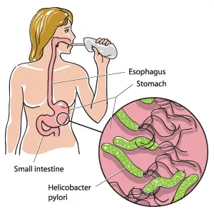 helicobacter