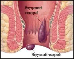 Metode populare de tratare a hemoroizilor