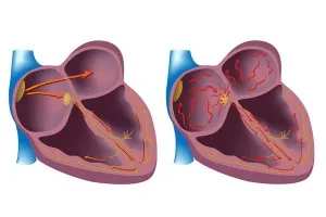 Principalele cauze și simptome ale aritmiei cardiace la femei