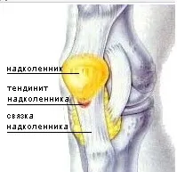 Болка зад коляното отзад дърпа характер - каква е причината