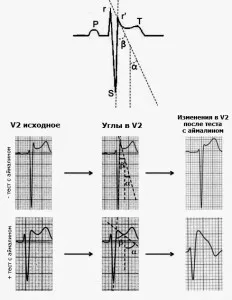 brugada