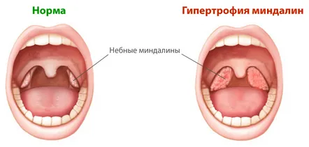 Tratamentul chirurgical al amigdalelor la copii