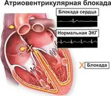 Blocuri atrioventriculare. Care sunt cauzele, ce terapie este necesară