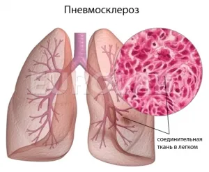 Pneumoscleroza, simptomele și tratamentul acesteia