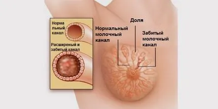 Lactostaza la o mamă care alăptează, simptome și tratamentul stagnării laptelui la sân