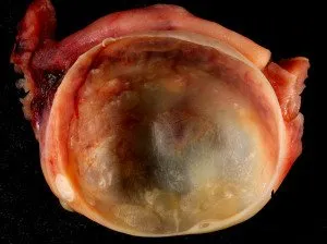 Chistul ovarian endometrioid