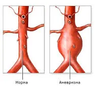 Caracteristicile principale ale anevrismului arterei splenice