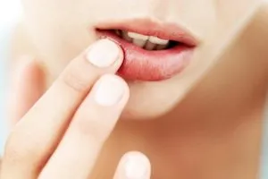 Herpes în timpul sarcinii, tratamentul exacerbării, consecințe, prevenire