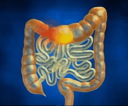 Simptomele, cauzele, diagnosticul și examinarea sindromului de colon iritabil