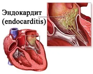 Care sunt simptomele endocarditei bacteriene caracteristice bolii