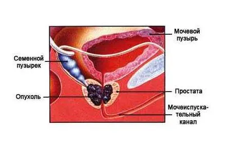 Caracteristicile simptomelor și tratamentul adenocarcinomului de prostată