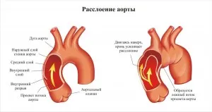 Disecția aortei, simptome și tratament folosind metode moderne