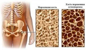 Prevenirea și tratamentul osteoporozei