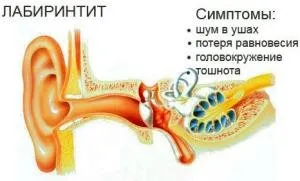 labirintită