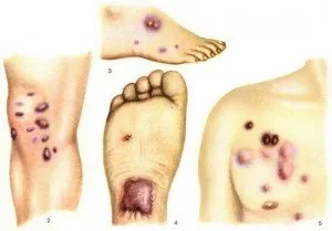 Cum să învinge sarcomul 13 metode de tratament cu remedii populare