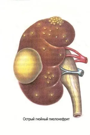 Paranefrita la copii definiție, simptome, diagnostic, tratament