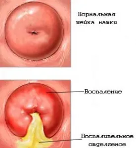 Simptomele, semnele și tratamentul cervicitei