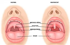 faringită