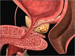 Tratamentul eficient al adenomului de prostată folosind remedii populare