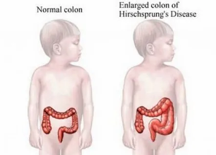 Boala Hirschsprung la copii - cum să recunoașteți și să tratați