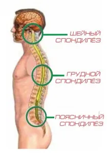 Totul despre spondiloza coloanei vertebrale și a regiunii lombare