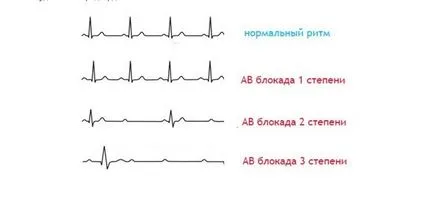 atrioventriculare