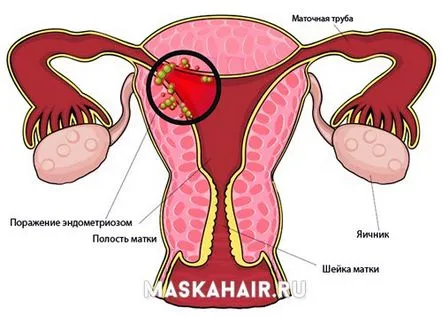 Cum să tratați adenomioza uterului Simptome, semne și recenzii