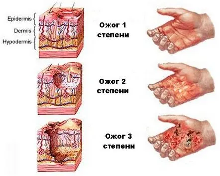 Tratamentul arsurilor de gradul 3