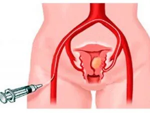 Chirurgie pentru îndepărtarea fibromului uterin