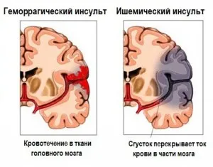 Tratament după un accident vascular cerebral cu remedii populare