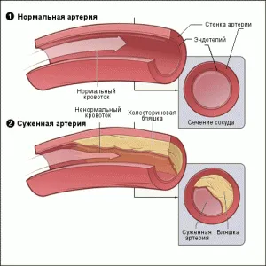 Tratamentul hipertensiunii arteriale