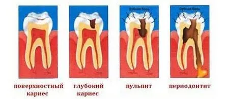 Cauze și tipuri de parodontoză cronică