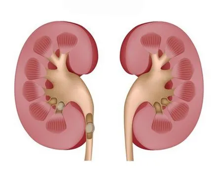 Pietrele de oxalat la rinichi, ce este și cum să-l tratezi