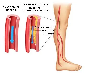 Ateroscleroza obliterată a vaselor extremităților inferioare, simptomele și tratamentul bolii