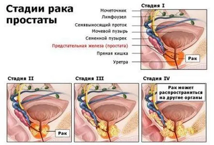 Ce trebuie să știți despre semnele cancerului de prostată la bărbați