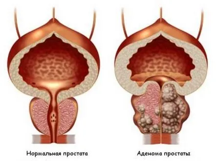 Cum se efectuează o operație pentru îndepărtarea unui adenom de prostată (glanda prostatică)