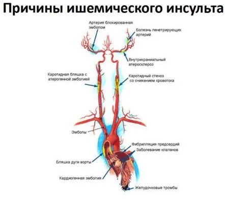 ischemică