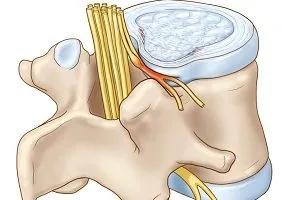 Ce poate fi protruzia periculoasă a vertebrelor cervicale, toracice și coloanei vertebrale lombare