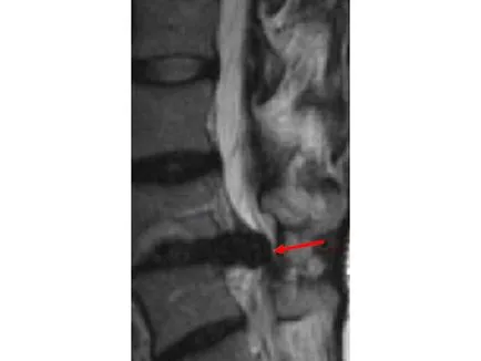 Bubnovskaya Center - fizioterapie, hernie de disc (hernie intervertebral), tratamentul cu un medic