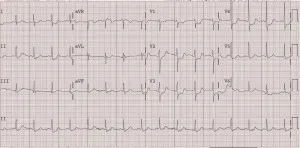 Care este primul ajutor premedical pentru infarctul miocardic