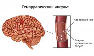 Infarct hemoragic