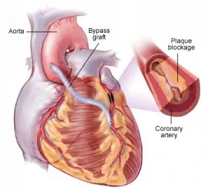 Grefa de bypass coronarian, ce este și care este costul tratamentului