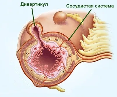 Diverticul intestinal și diverticuloza