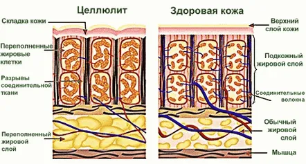 Celulita, problema sau deficienta feminina, defect sau boala inflamatorie