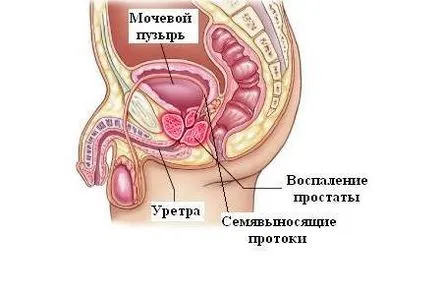 Manifestările prostatitei calculoase și caracteristicile tratamentului acesteia