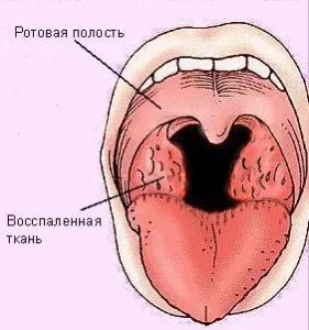 Cât de periculoasă este angina pectorală virală