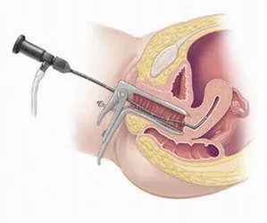 Ce este histeroscopia uterului, cum să vă pregătiți corect pentru operație