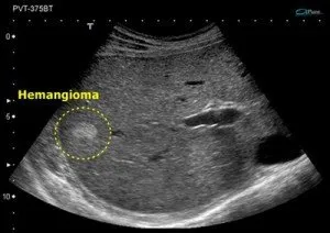 Hemangiom hepatic