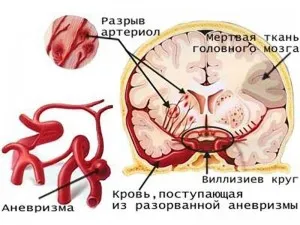 Anevrism al vaselor cerebrale - de ce este periculos